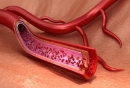 血管畸形是什么原因造成的